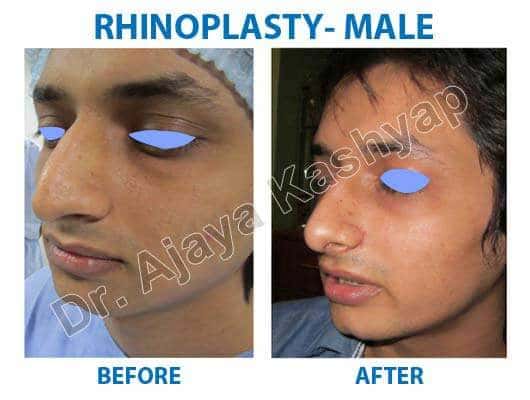 best facial plastic surgeon in india