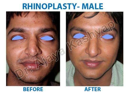 how much cost for plastic surgery in india
