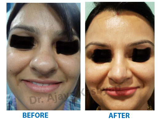 how much cost for plastic surgery in india