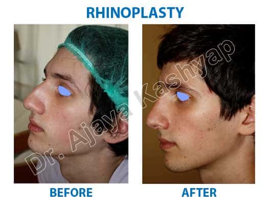 nose cosmetic surgery in delhi