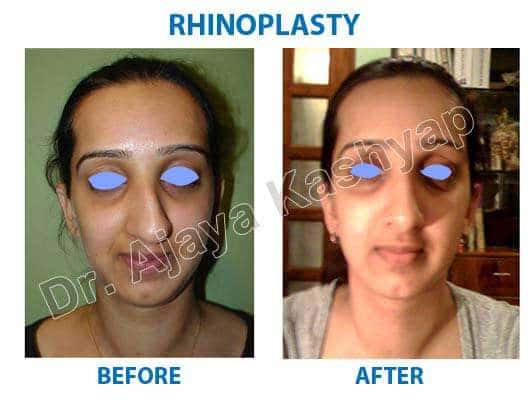 nose correction surgery cost in india