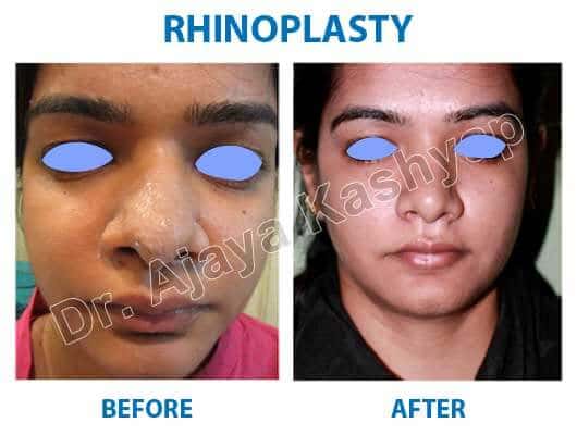 top rhinoplasty surgeon in india