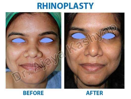 best rhinoplasty surgery hospital in india