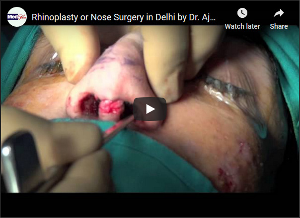 rhinoplasty video pic